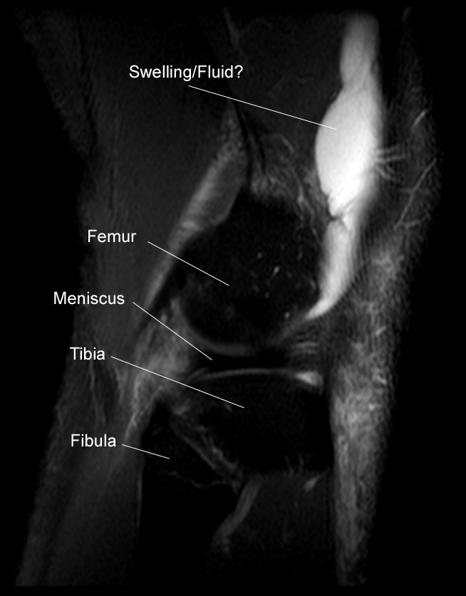 Saggital view of knee